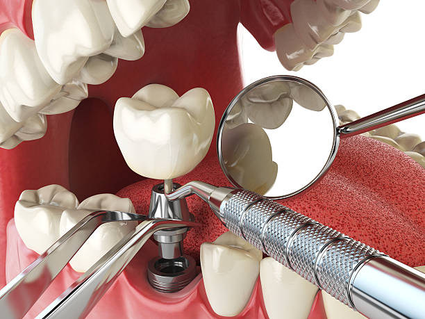 Best Emergency Root Canal Treatment in Midvale, UT