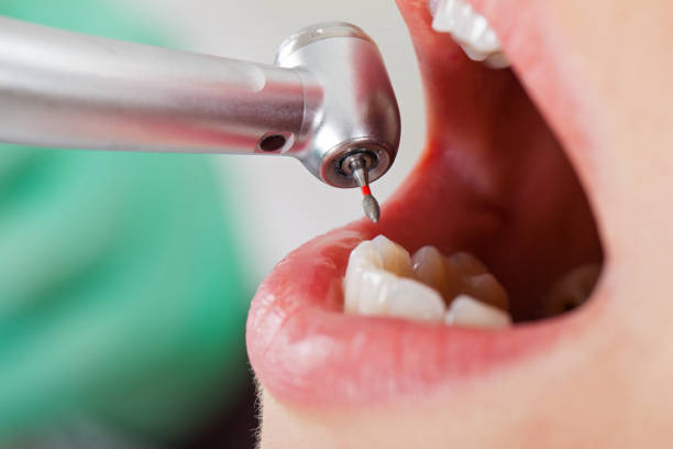 Best Emergency Tooth Extraction in Midvale, UT